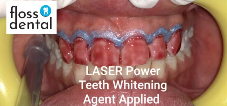 Is a Teeth Whitening Procedure Right For You?