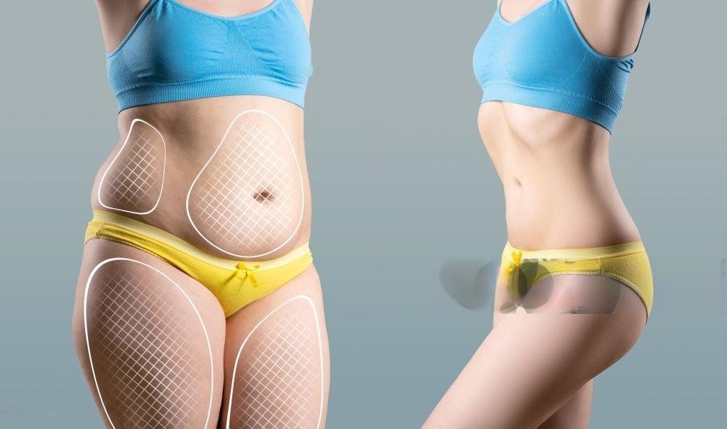 Liposuction in Dubai